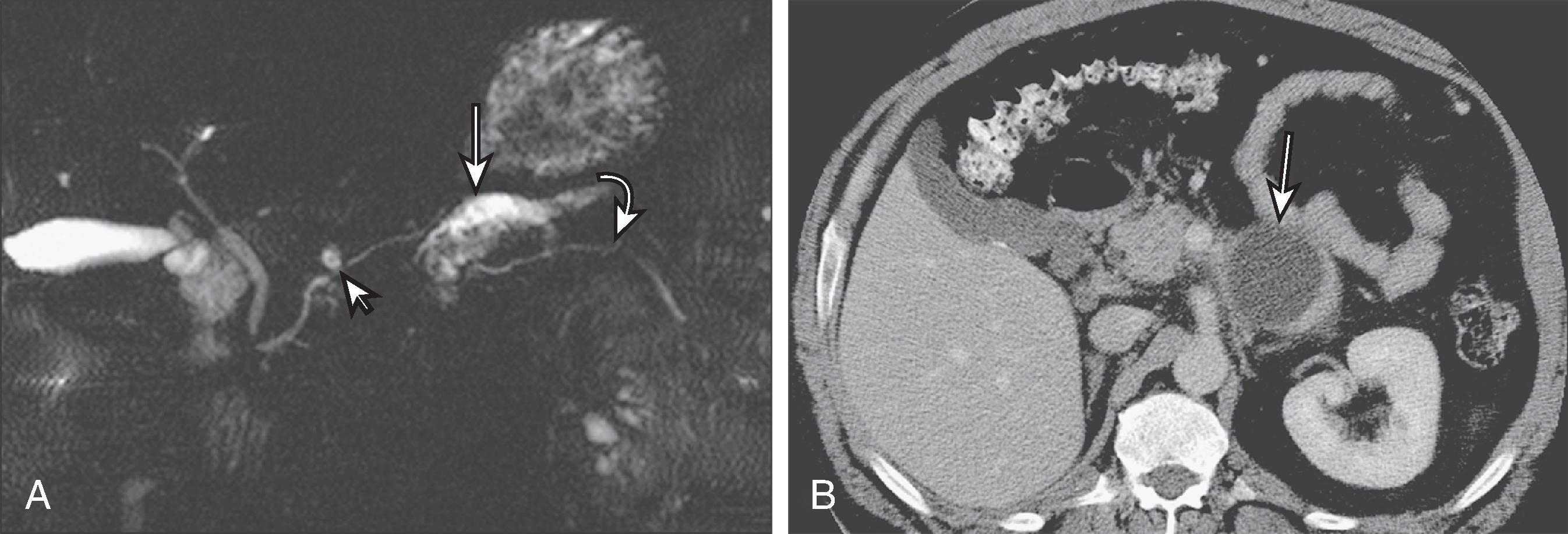 Fig. 61.5, Pancreatic duct injury and subsequent pseudocyst formation.