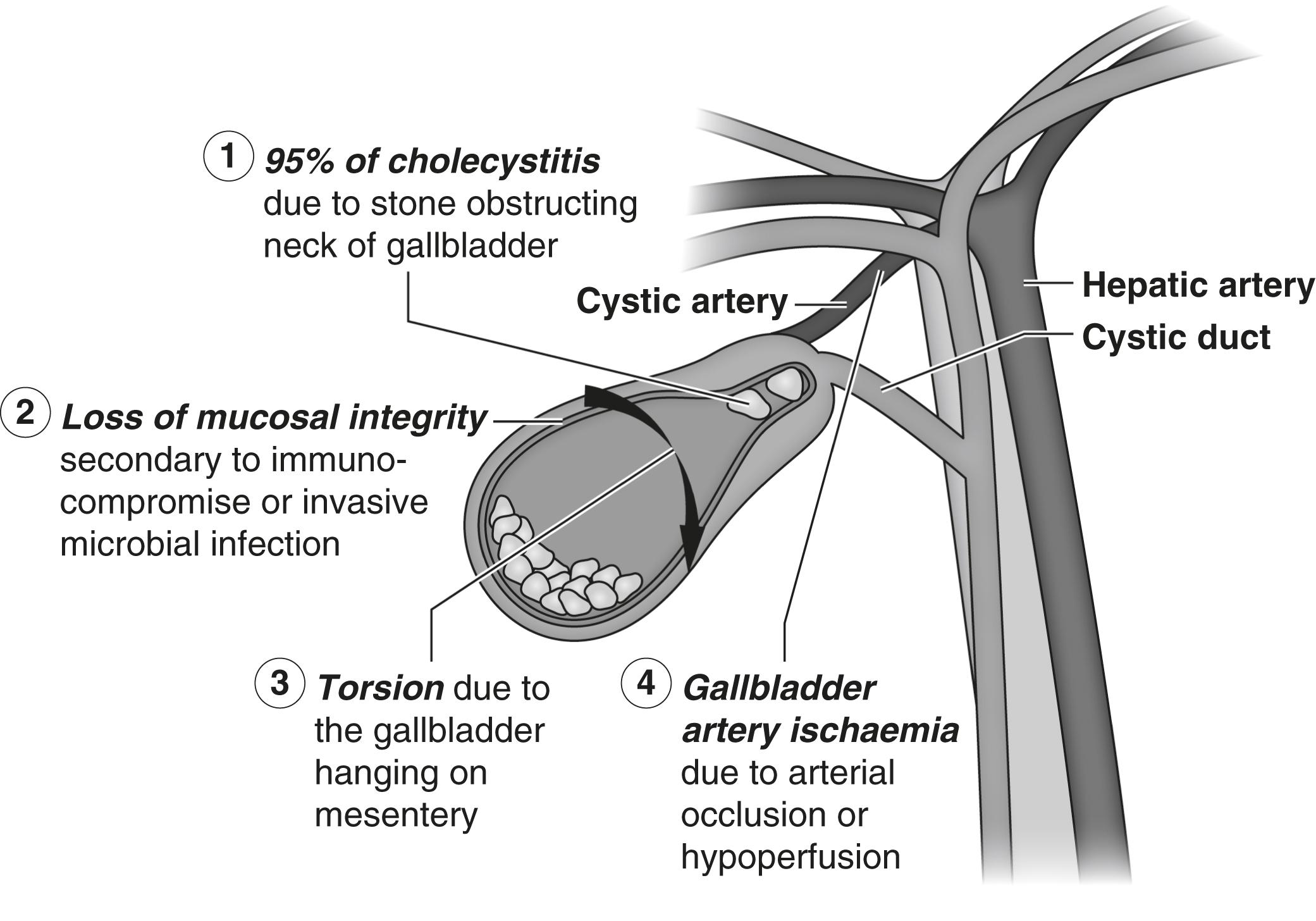 Figure 14.2, Aetiology of acute cholecystitis and its complications.