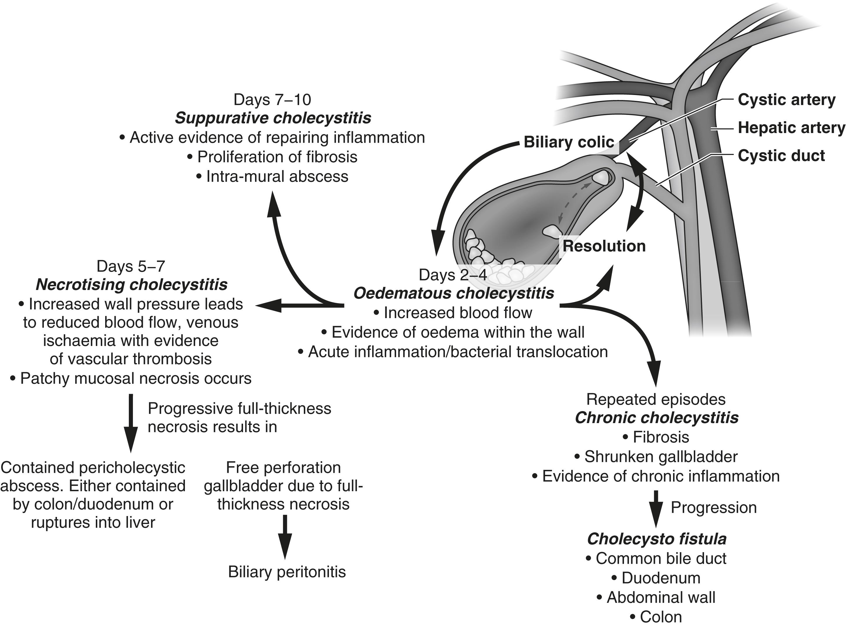 Figure 14.3, Pathogenesis of acute cholecystitis and its complications.