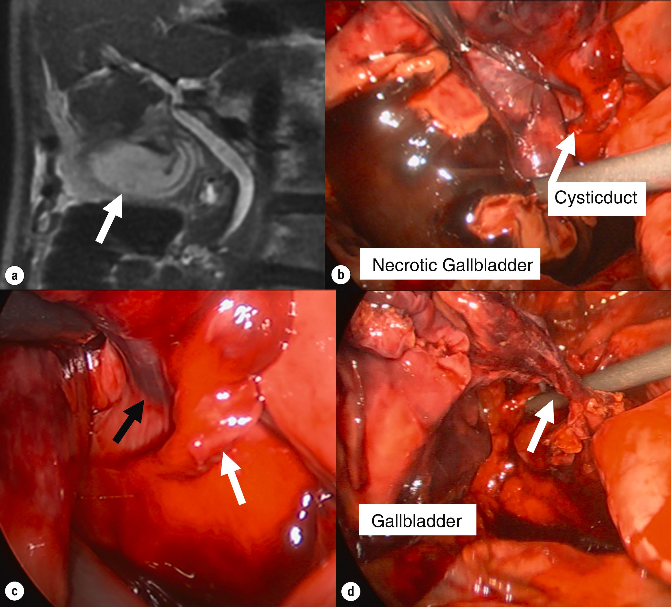 Figure 14.4, An 86-year-old man presents with predicted moderate acute cholecystitis. Magnetic resonance imaging (MRI) shows features of cholecystitis. Note transverse orientation of gallbladder on MRI (a, white arrow ). At surgery, a necrotic gallbladder secondary to acute torsion is observed (b) . The cystic duct is twisted ( c , white arrow ) and a narrow mesentery can be seen ( c , black arrow ) and the gallbladder lies free of the hepatic surface. With the gallbladder detorted and small mesentery divided the gallbladder can be seen attached by cystic duct alone ( d , white arrow ). Caution is required given lack of classical landmarks to guide safe cholecystectomy.