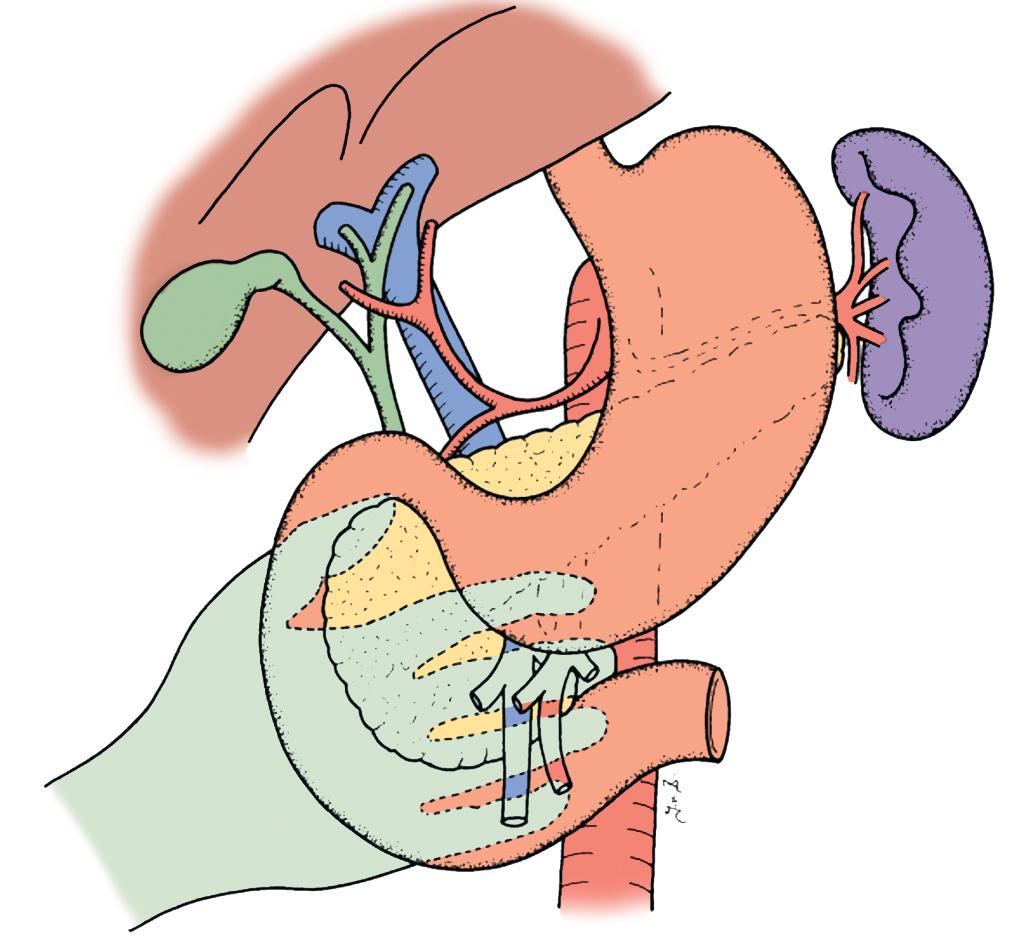 FIGURE 117A.1, Adequate Kocherization to facilitate assessment of the retroperitoneum and the relation of the tumor to the vascular structures.