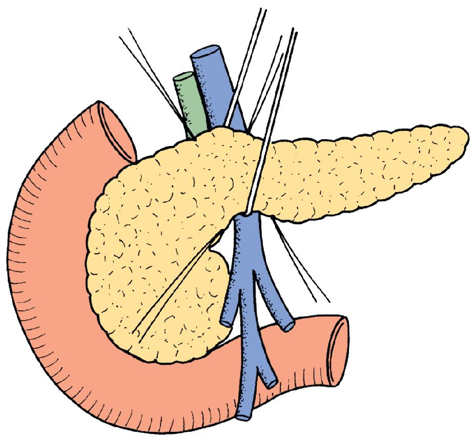 FIGURE 117A.3, Full development of the pancreatic neck may allow for safe passage of a Penrose drain or clamp anterior to the portal vein.