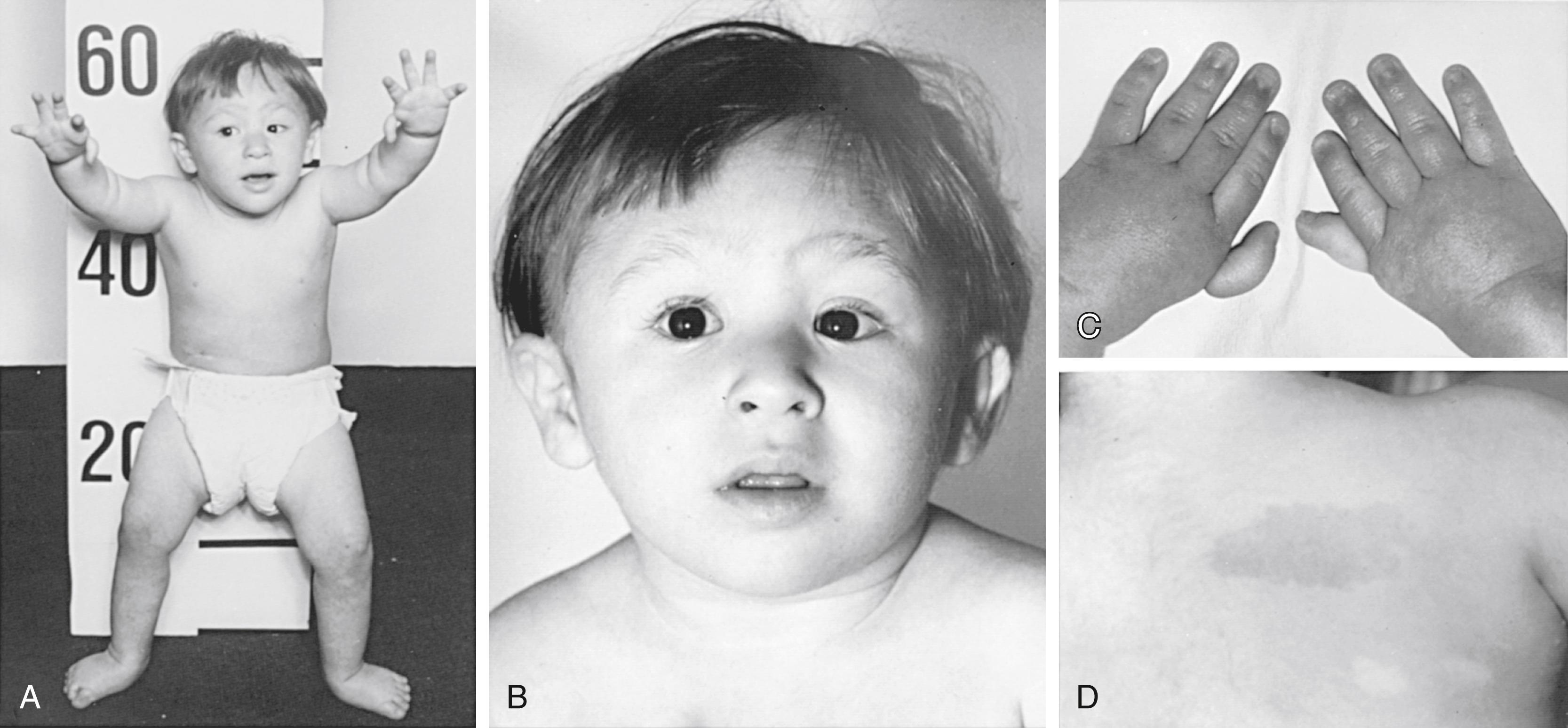 Fig. 50.1, A 3-year-old boy with Fanconi anemia who exhibits several classic phenotypic features. A, Front view. B, Face. C, Hands. D, Back right shoulder. The features to be noted include short stature, dislocated hips, microcephaly, a broad nasal base, epicanthal folds, micrognathia, thumbs attached by a thread, and café-au-lait spots with hypopigmented areas beneath.