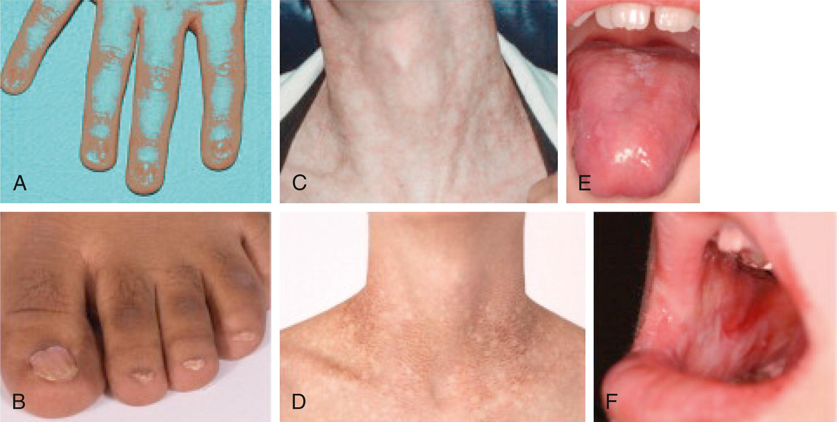 Fig. 50.2, Features of the diagnostic triad in dyskeratosis congenita. A, B, Dystrophic nails on hands and feet. C, D, Lacy reticular pigmentation on neck and upper thorax. E, F, Oral leukoplakia on tongue and buccal mucosa.