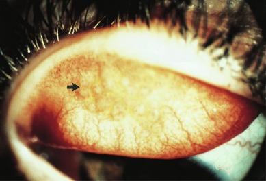 Fig. 14.2, Contact lens–induced papillary conjunctivitis (CLPC) in a rigid-lens wearer, with more papillae observed (arrow) towards the lash margin.