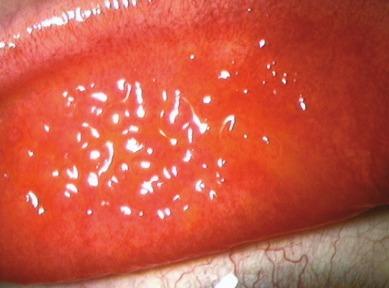 Fig. 14.4, Irregular light reflexes in contact lens–induced papillary conjunctivitis.