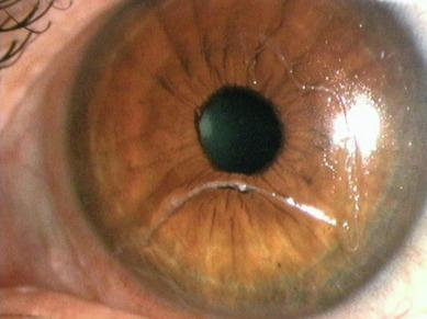 Fig. 14.6, Strand of mucus on the surface of a soft lens in a patient with contact lens–induced papillary conjunctivitis.