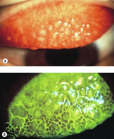 Fig. 14.7, Scarring at the apex of papillae, seen here (A) in white light and (B) cobalt blue light (right).