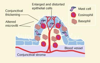 Fig. 14.8, Pathological changes that characterise a papilla.