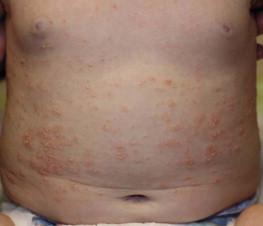 Figure 16.1, Infant with guttate psoriasis.