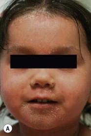 Figure 16.11, (A,B) A 2 year-old child with classic juvenile PRP. Note the facial taughtness and erythroderma admixed with islands of sparing. (C) Characteristic keratotic papules. (D) Waxy keratoderma.