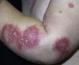 Figure 16.2, Annular psoriasis on the arm of an infant.