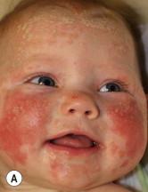 Figure 16.3, Psoriasis with: (A) Facial and (B) anogenital involvement; this infant also has guttate psoriasis (see Fig. 16.1 ).