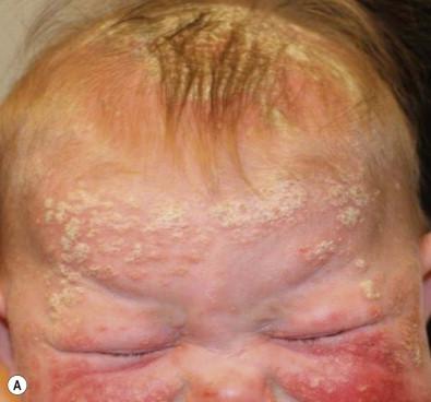 Figure 16.4, Severe facial and scalp psoriasis.