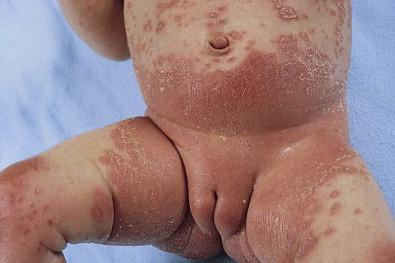 Figure 16.6, Diaper psoriasis with dissemination.