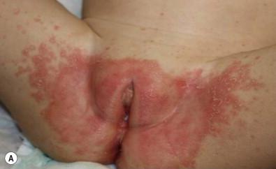 Figure 16.7, A 19-month-old child with Candida diaper dermatitis with widespread psoriasiform id reaction.