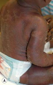 Figure 16.8, Generalized pustular psoriasis.