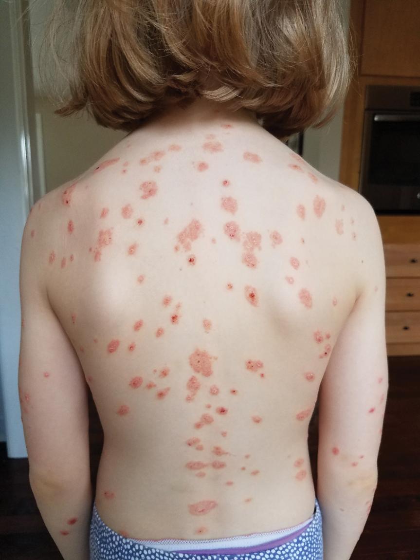 Fig. 4.1, Psoriasis. Typical small plaques on the back and arm in this girl with generalized involvement.