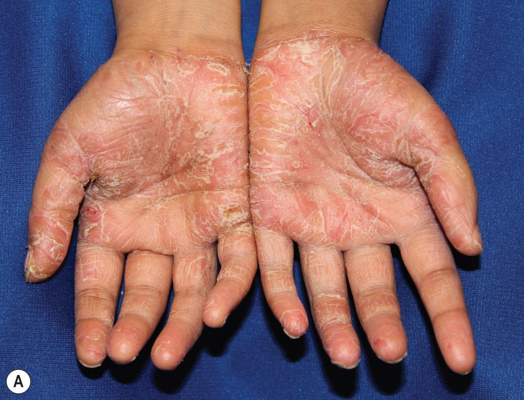 Fig. 4.12, Psoriasis. Involvement of the psoriasis on the palms (A) and soles (B) .