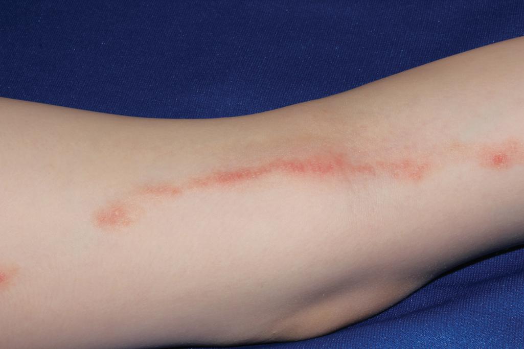 Fig. 4.13, Linear psoriasis. This patient first developed this streak of erythema and mild scaling at 5 years of age. Generalized psoriasis had its onset after a streptococcal infection 18 months later. Later treatment with ustekinumab led to clearance of both the linear psoriasis and the generalized plaques of psoriasis (shown in Fig. 4.1 ).