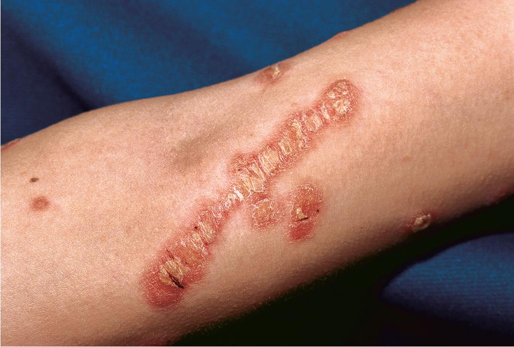 Fig. 4.14, Psoriasis. This patient shows the Koebner phenomenon, with development of a linear plaque of psoriasis after trauma to the arm.