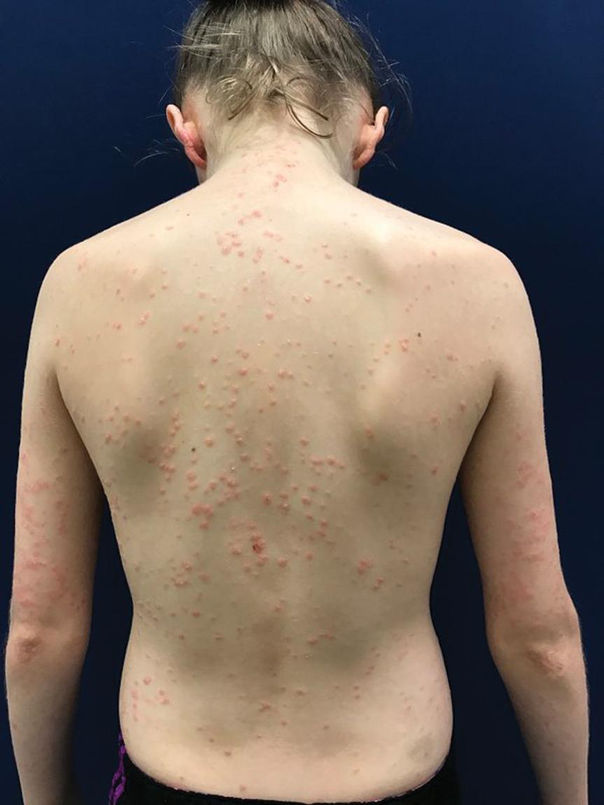 Fig. 4.15, Psoriasis. Sunburn on the upper chest and neck led to a flare in an adolescent previously in excellent control.