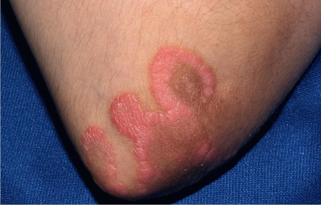 Fig. 4.16, Psoriasis. Annular plaques on the elbow. Note the central clearing, leaving hyperpigmentation.