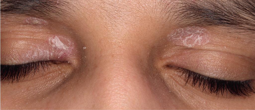 Fig. 4.17, Psoriasis. Eyelid involvement is often mistaken for atopic or contact dermatitis.