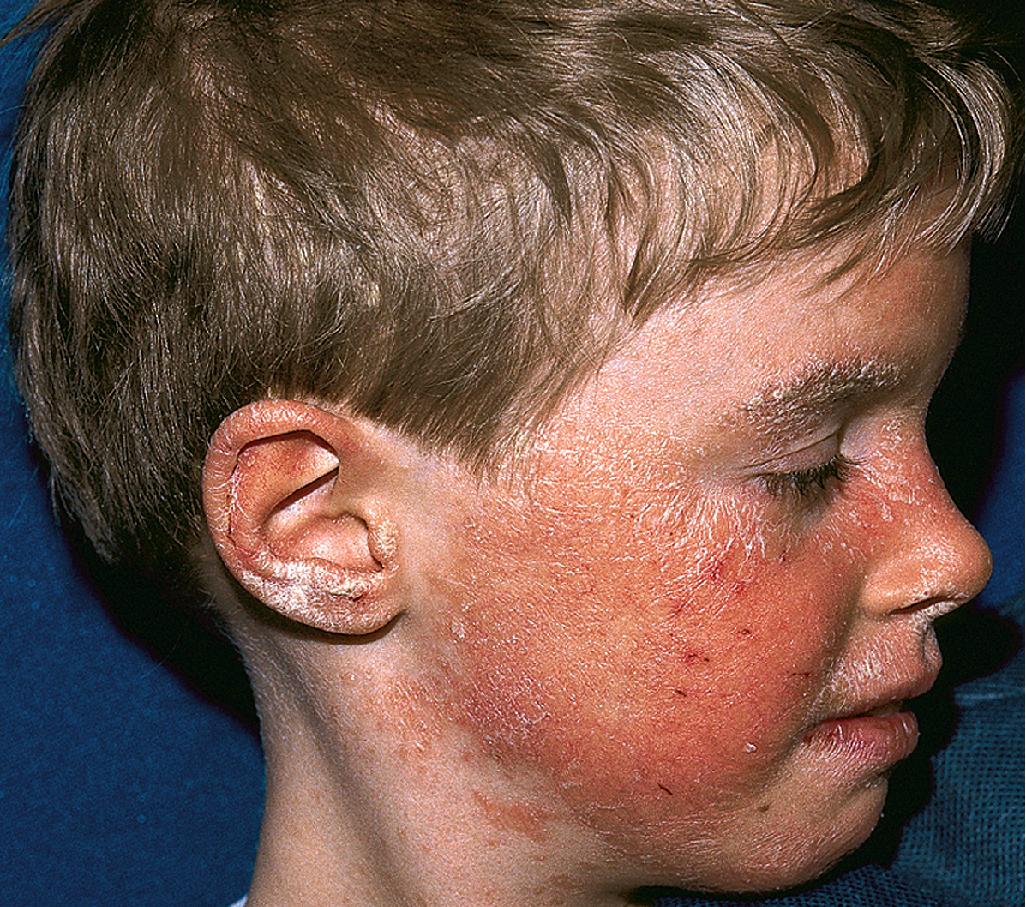 Fig. 4.18, Psoriasis. Facial psoriasis most commonly involves the periorbital area, but more extensive facial involvement can occur.