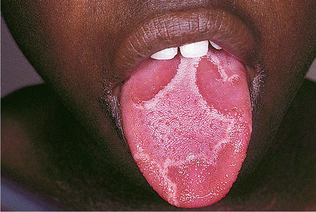 Fig. 4.19, Psoriasis. Geographic tongue can be seen as the most common mucosal manifestation of patients with psoriasis.