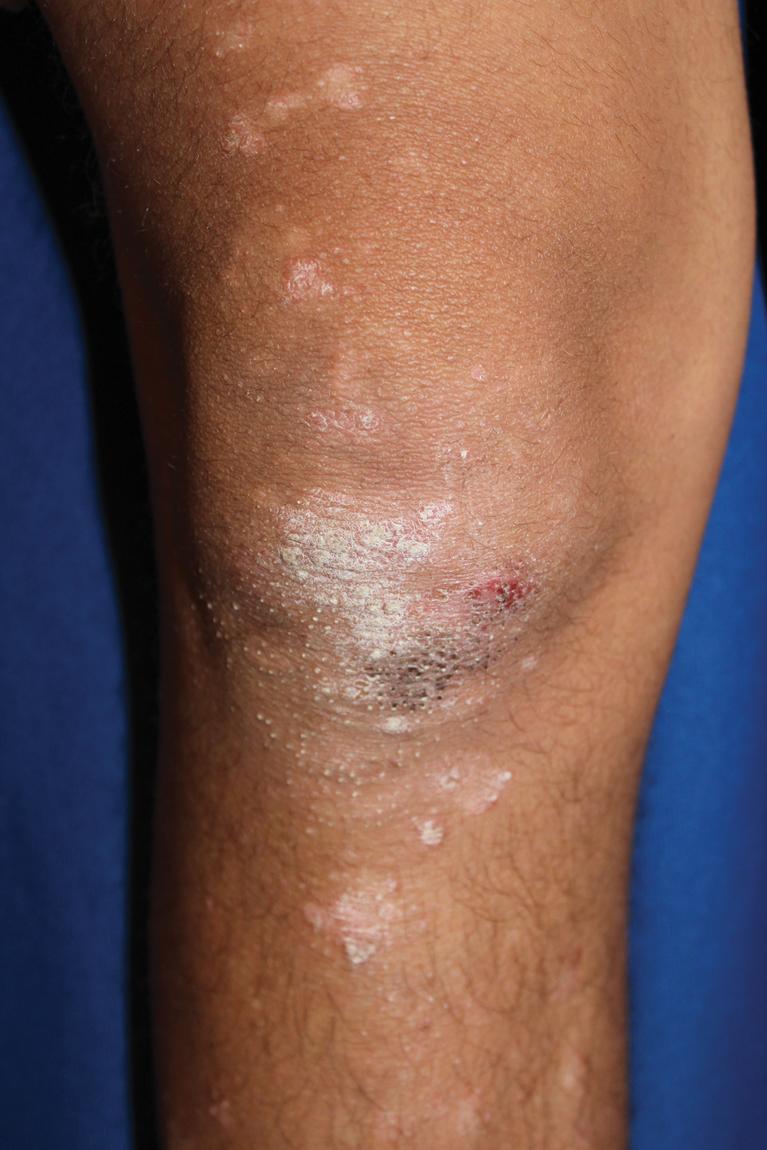 Fig. 4.2, Follicular psoriasis. Scaling follicular-based papules, especially on the knees or elbows, may be a feature of psoriasis but are generally accompanied by more typical or larger plaques that enable the diagnosis and distinguish it from pityriasis rubra pilaris.