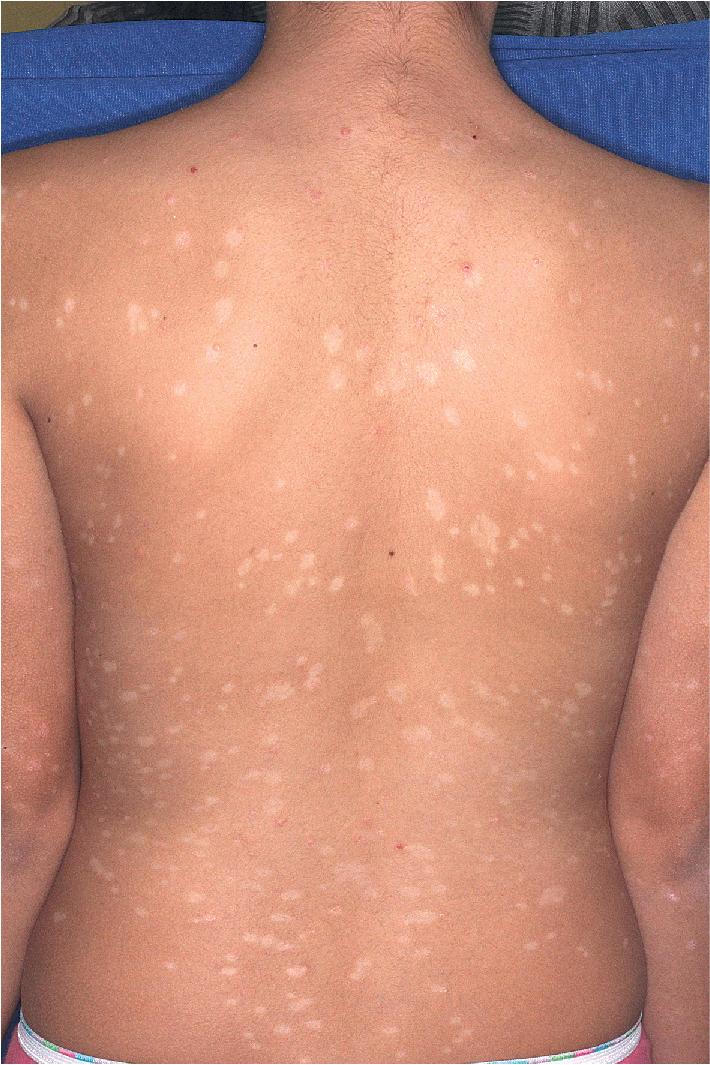 Fig. 4.21, Guttate psoriasis. These small hypopigmented macules are the postinflammatory residual lesions of guttate psoriasis.