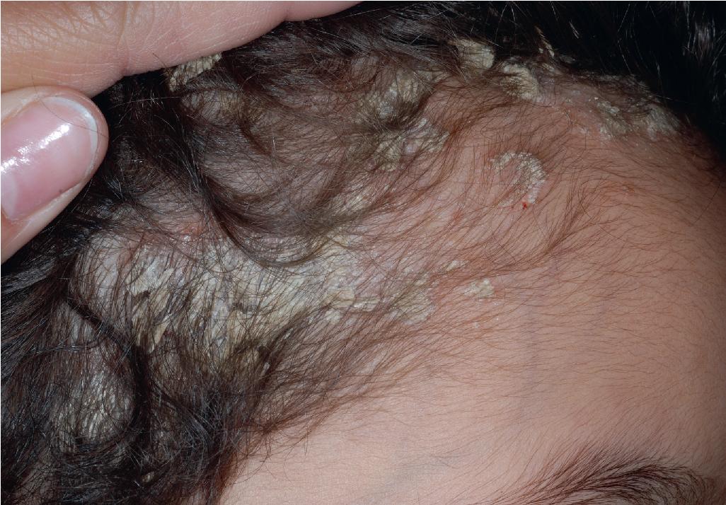 Fig. 4.22, Scalp psoriasis. Thick, discrete scaling overlying erythema on the scalp.