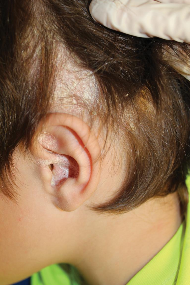 Fig. 4.23, Scalp psoriasis. Scaling on the scalp and within the antihelix of the ear.