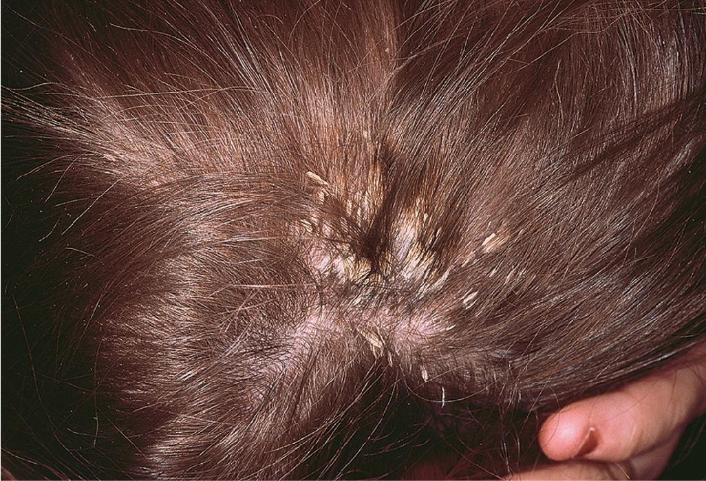 Fig. 4.25, Pityriasis (tinea) amiantacea. In this severe form of psoriasis of the scalp, the scales are strongly adherent (asbestos-like).