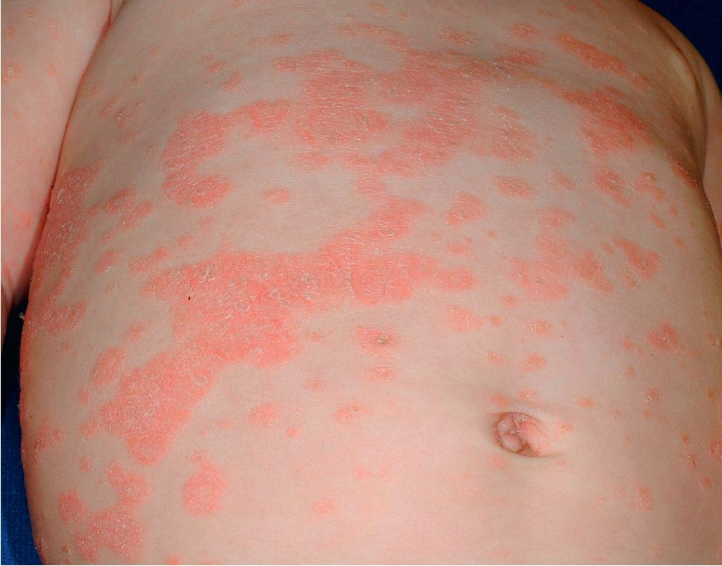 Fig. 4.26, Psoriasis in an infant. In addition to diaper-area involvement, this infant showed disseminated plaques of typical psoriasis.