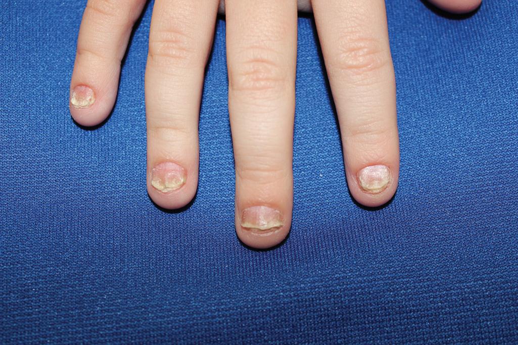 Fig. 4.27, Nail psoriasis. Several fingers show severe onycholysis with oil spots and nail pitting.