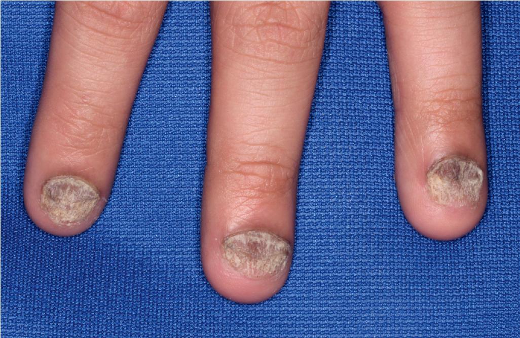 Fig. 4.28, Nail psoriasis. Note the trachyonychia or rough, ridged longitudinal striations, sometimes called sandpapered nails (see Chapter 7 ).