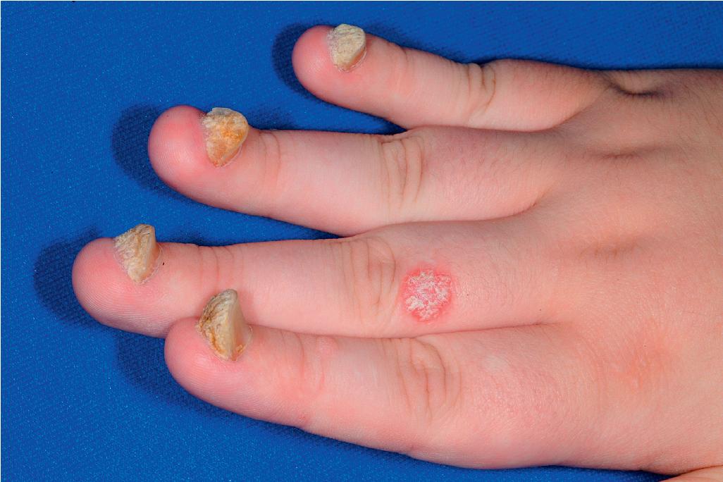 Fig. 4.29, Nail psoriasis. Extensive subungual hyperkeratosis in a teenager. Note the isolated small plaque on one finger.