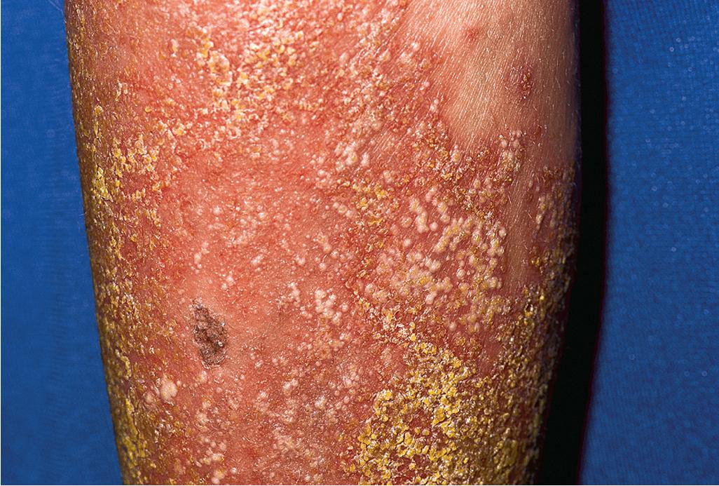 Fig. 4.30, Pustular psoriasis. Collections of small pustules, some with an annular configuration, overlying bright erythema.