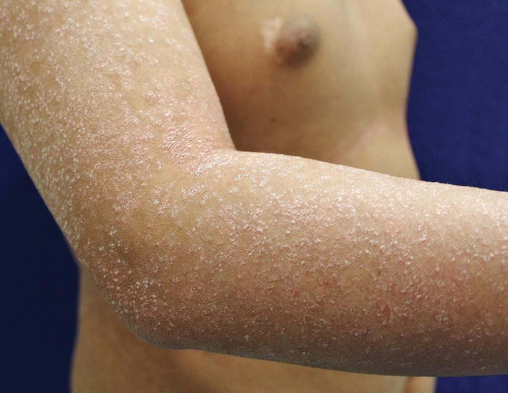 Fig. 4.3, Follicular psoriasis. The extremities were studded with follicular-based erythematous papules but the patient also had typical psoriatic lesions.