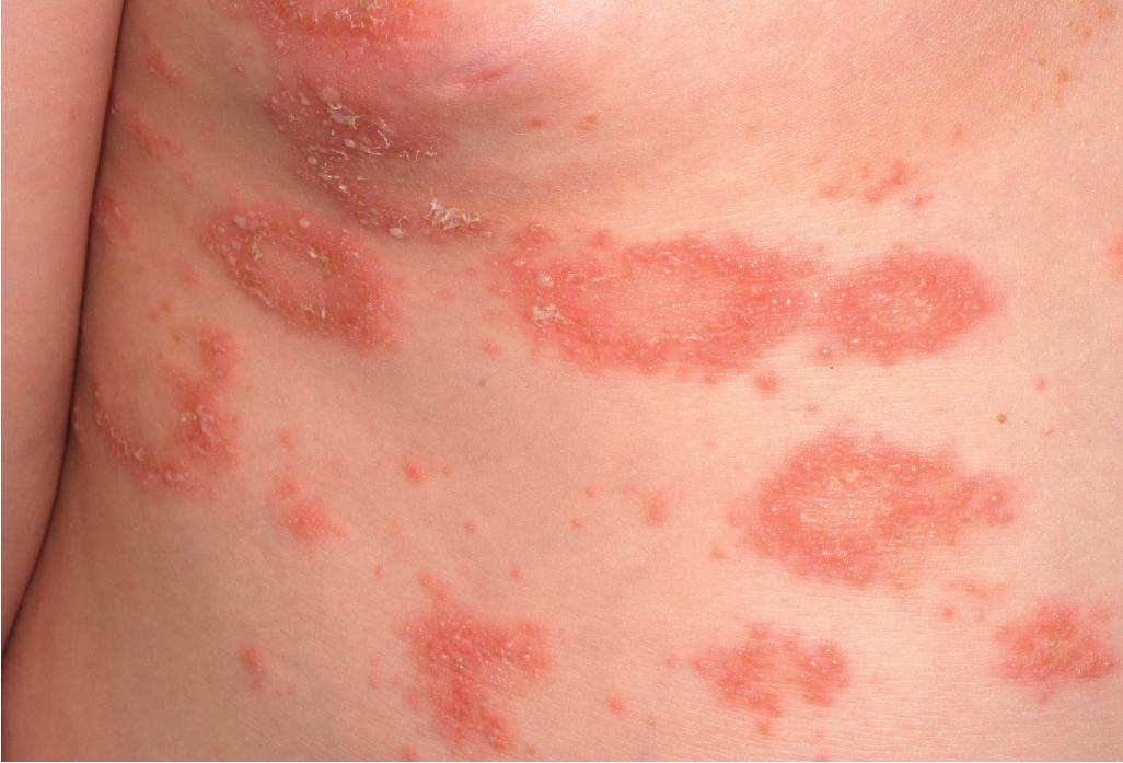 Fig. 4.31, Pustular psoriasis. Note the annular configuration of the pustules.