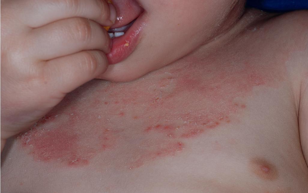 Fig. 4.32, Localized pustular psoriasis in an infant. In infants, pustular psoriasis may be localized to intertriginous areas, particularly the neck fold, and be confused with dermatitis or infection. This form is difficult to treat and may eventuate in generalized pustular psoriasis.