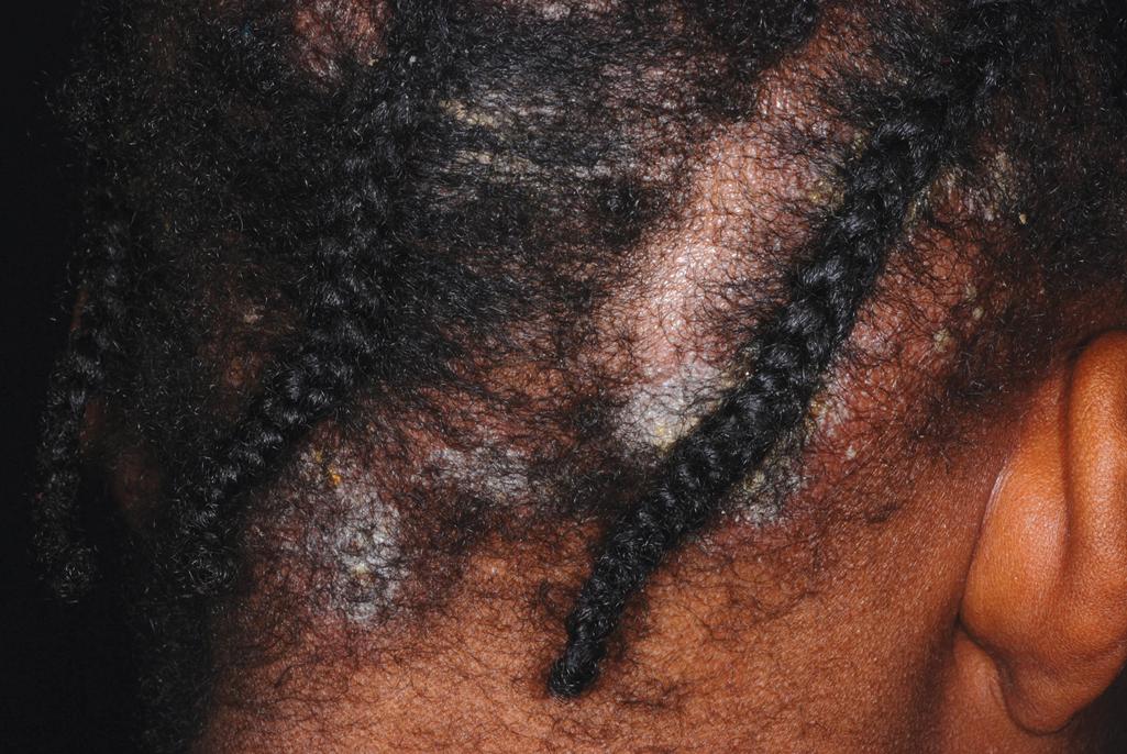 Fig. 4.4, Scalp psoriasis. Discrete plaques of scale overlying erythema. Oiling of the scalp may observe the scaling and make diagnosis more challenging. If concomitant alopecia or lymphadenopathy is present, tinea capitis needs to be considered, especially if psoriasis is confined to the scalp.