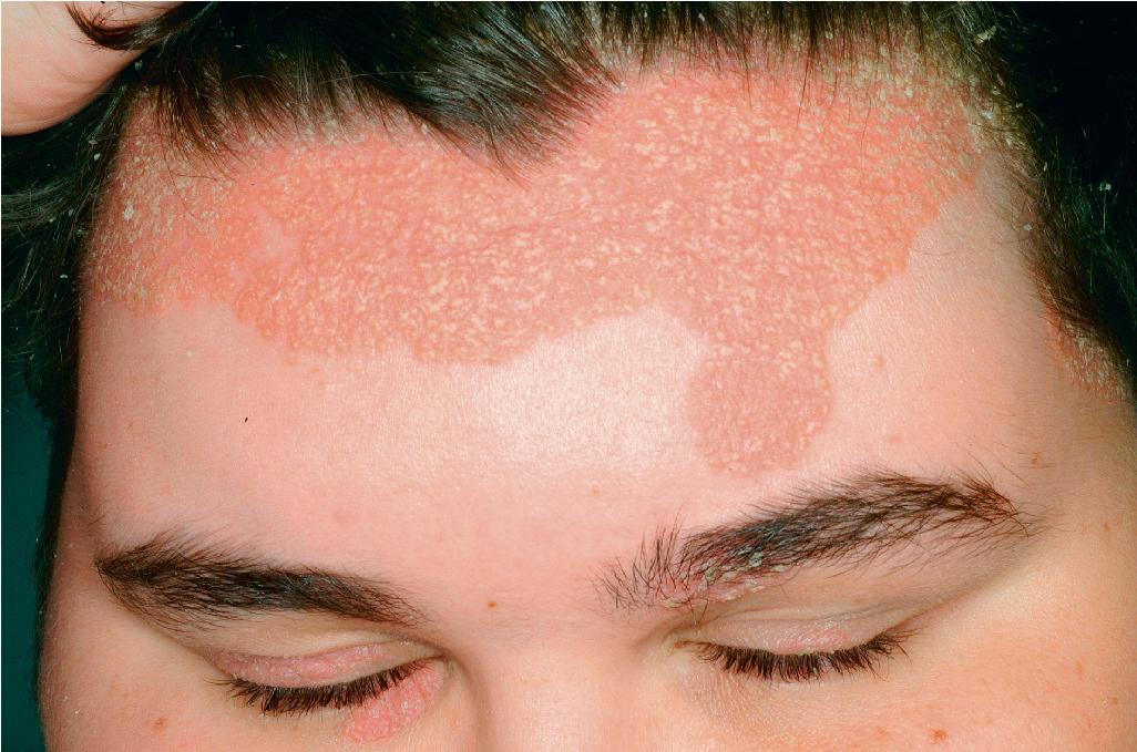 Fig. 4.5, Psoriasis. Psoriasis often involves the forehead, particularly contiguous to the scalp. Note the eyelid and brow involvement. Given the yellowish scaling, this has been called sebopsoriasis.