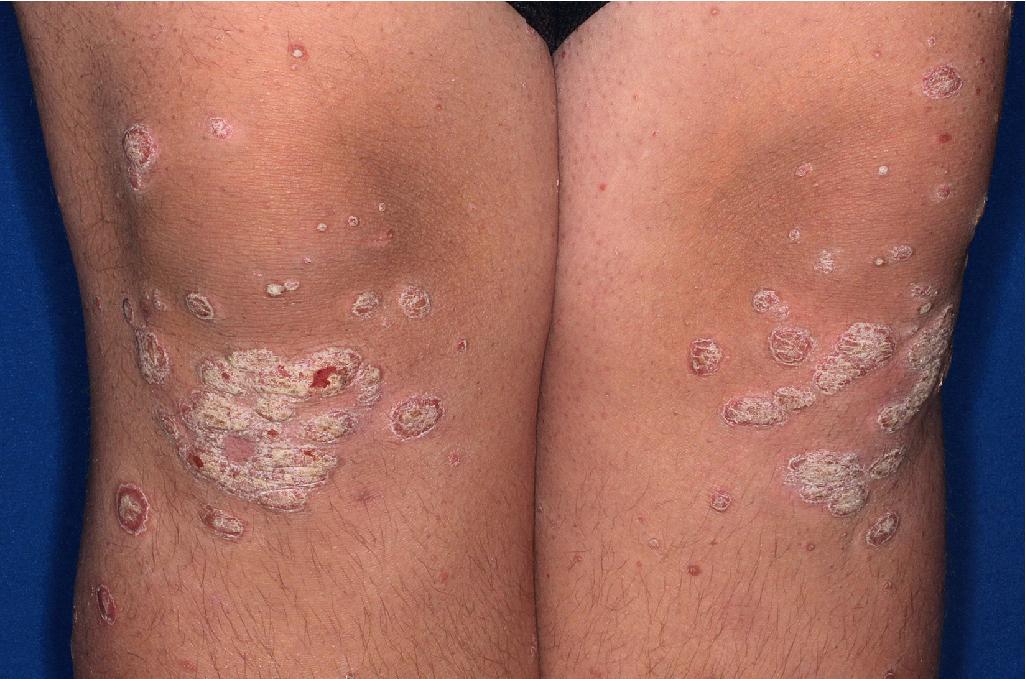 Fig. 4.6, Psoriasis. Typical plaques of psoriasis with thick, micaceous scale overlying erythema on the knees.