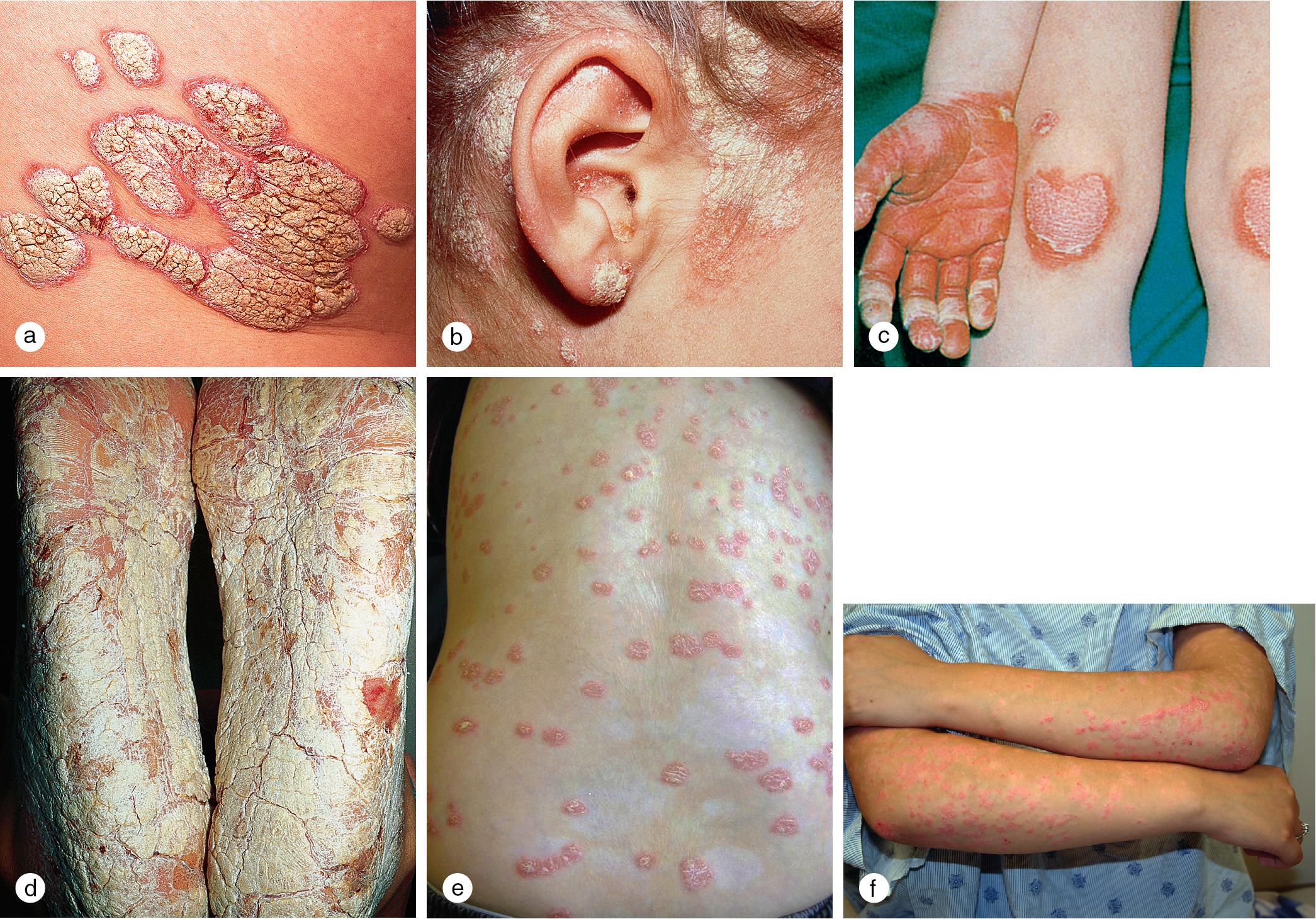 Fig. 3.1, Psoriasis. (a) Typical erythematous plaques are topped by a silver scale on the trunk of an adolescent. (b) Thick, tenacious scale extends from the forehead, neck, and ears onto the scalp of this 10-year-old girl. (c) Thick plaques on the palms, soles, elbows, and knees of this 8-year-old boy caused severe pain when he attempted to walk or use his hands. (d) Another boy with an impressive plantar keratoderma had difficulty walking. (e) Widespread guttate lesions erupted on the trunk and extremities of this healthy 9-year-old boy 1 week after a streptococcal pharyngitis. (f) Disseminated guttate lesions also developed on this 13-year-old girl after an upper respiratory infection.