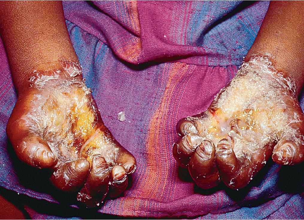 Fig. 3.11, Olmsted syndrome. Severe scarring keratoderma of the palms and soles was associated with perioral and perigenital hyperkeratosis, hyperhidrosis, recurrent cutaneous infections, and poor growth in this 5-year-old girl. Treatment with oral retinoids resulted in some decrease in the palmar and plantar lesions.