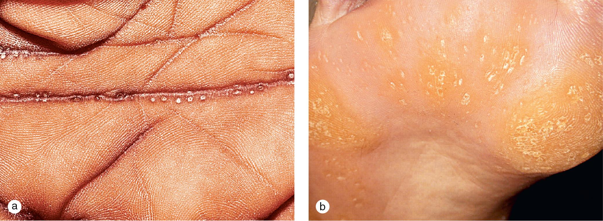 Fig. 3.12, Focal keratoderma. Asymptomatic hyperkeratotic papules and pits (a) developed on the hand creases of an African American teenager. Painful punctuate papules and pits began in adolescence on the palms and (b) soles of this young man similar to lesions on his father, uncle, grandfather, and several siblings.