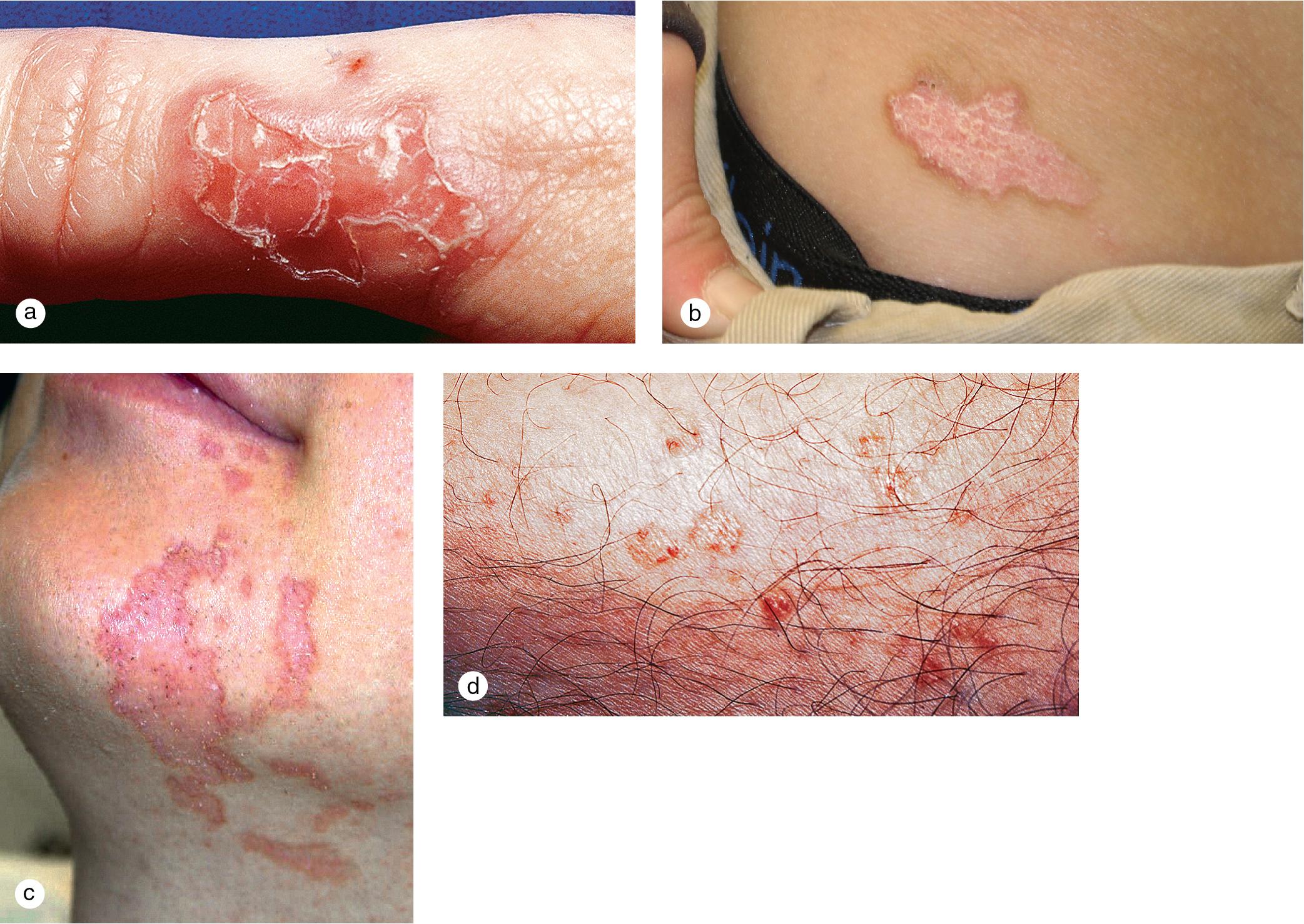 Fig. 3.13, Porokeratosis. Porokeratosis of Mibelli on (a) the thumb, (b) the right hip, and (c) the chin. (d) This adolescent with disseminated superficial actinic porokeratosis began to develop asymptomatic nummular patches on his legs after a sunburn when he was 16 years old. Note the hyperkeratotic borders in all of the patients, which demonstrated a coronoid lamella on skin biopsy. All lesions were slowly progressive.